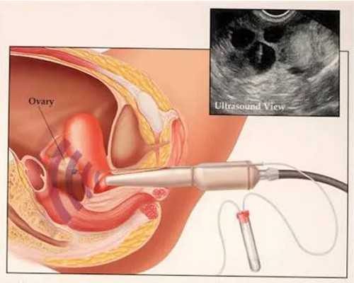 成都西南供卵医院,成都正规供卵医院